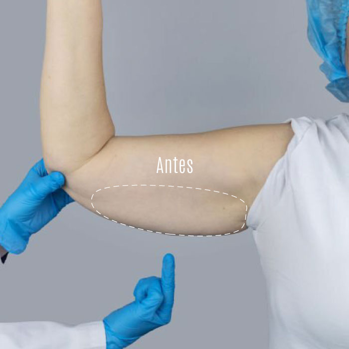 CG-ENDOSCULPT-braços-antes