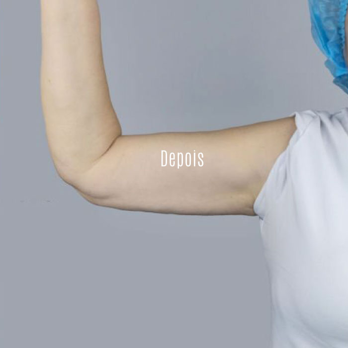 CG-ENDOSCULPT-braços-depois