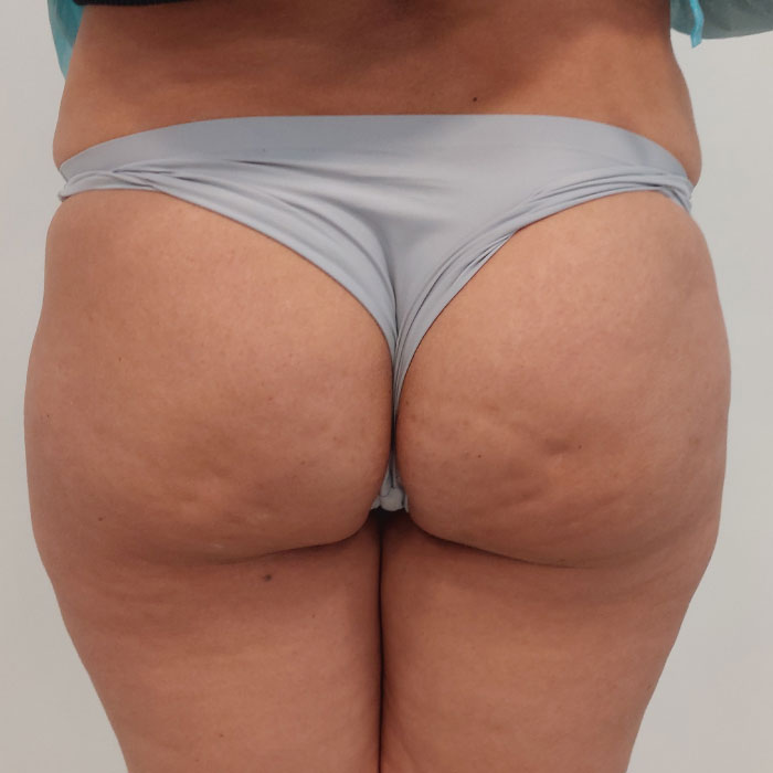 CG-ENDOSCULPT-gluteos-antes