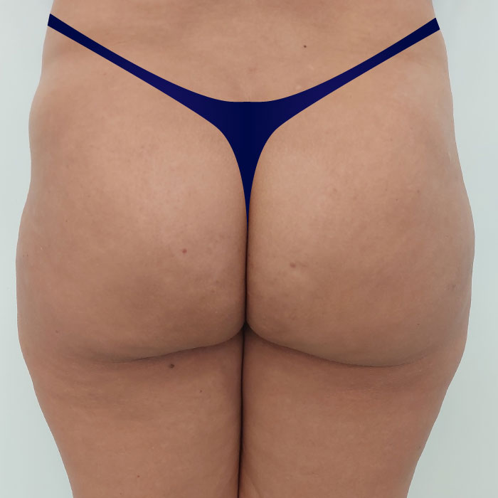 CG-ENDOSCULPT-gluteos-depois1
