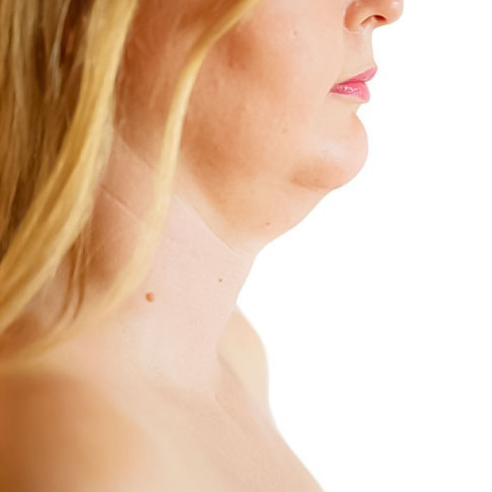 CG-ENDOSCULPT-papada-antes