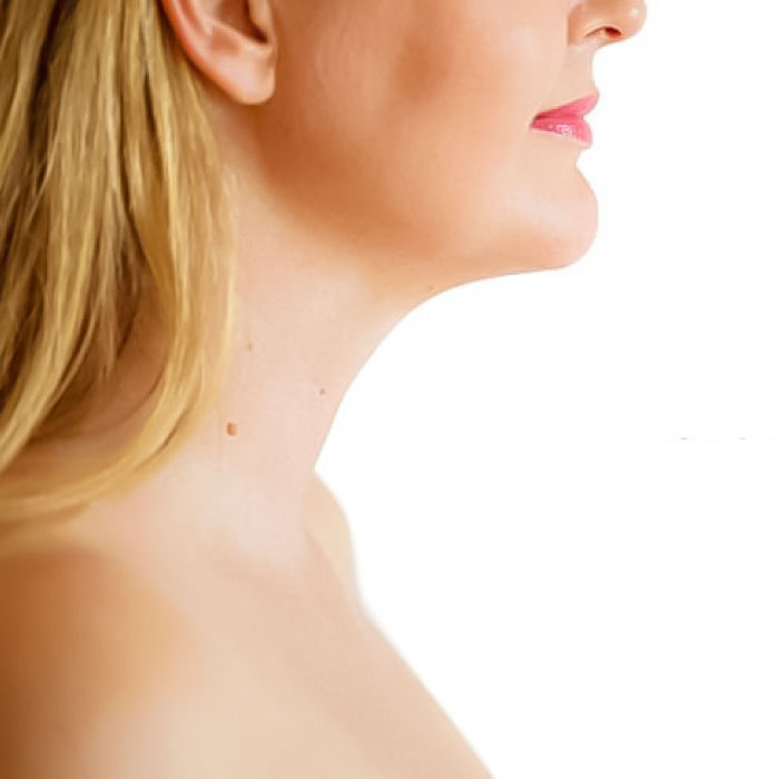 CG-ENDOSCULPT-papada-depois