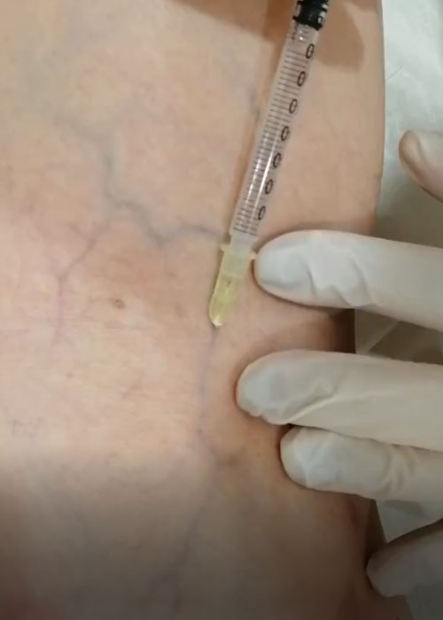 CG-A-escleroterapia2