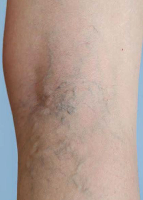 CG-A-escleroterapia3