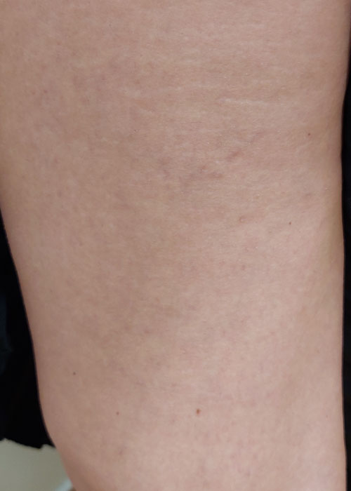 CG-D-escleroterapia1