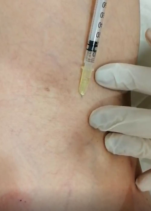 CG-D-escleroterapia2