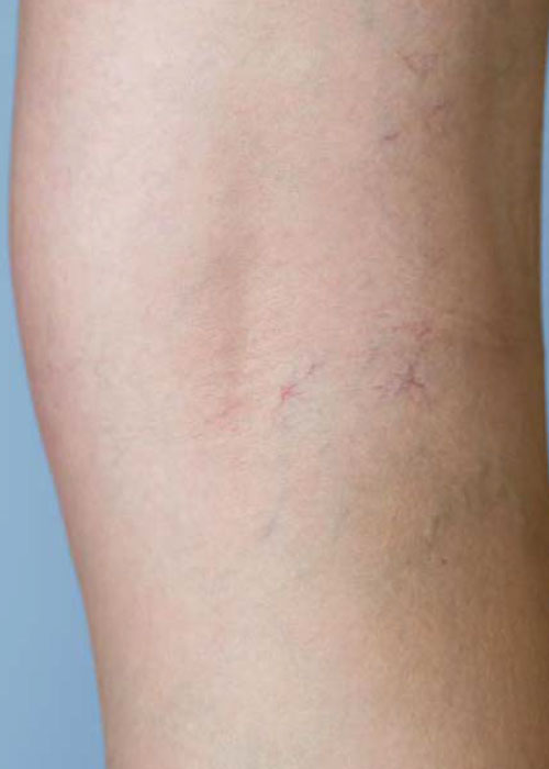 CG-D-escleroterapia3